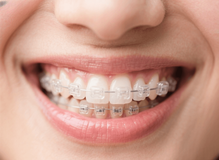 Ceramic clear braces