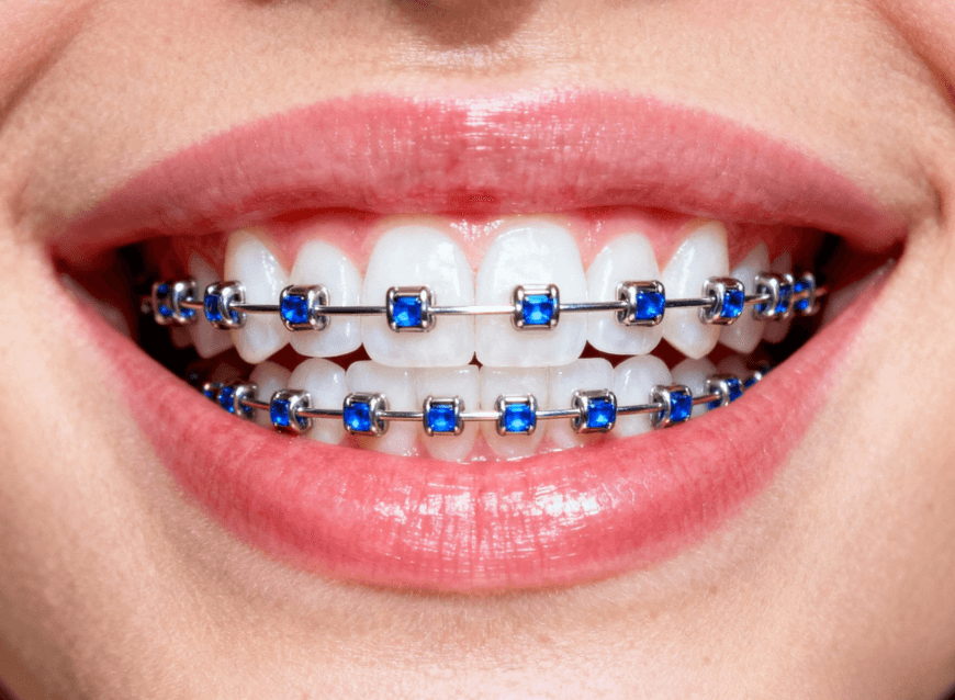 Colored personalized metal braces