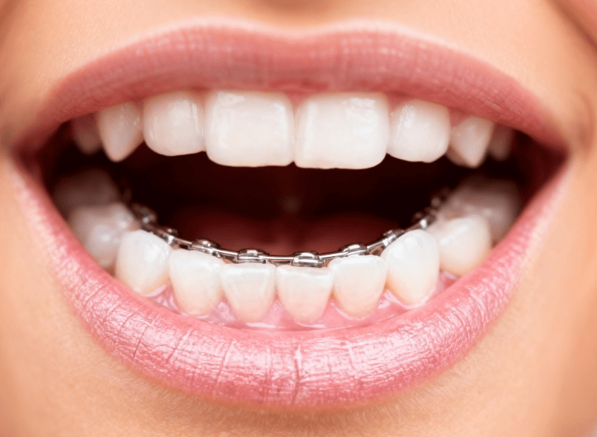 Lingual braces