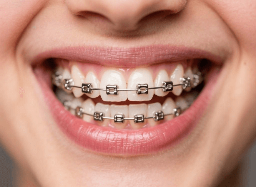 Traditional metal braces
