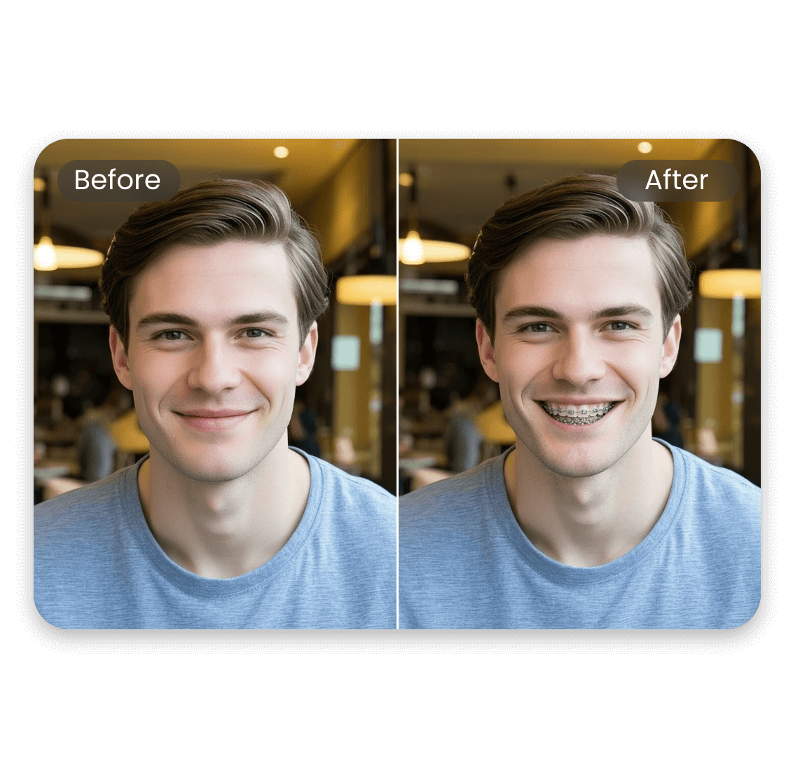 Braces elter works even without a smile